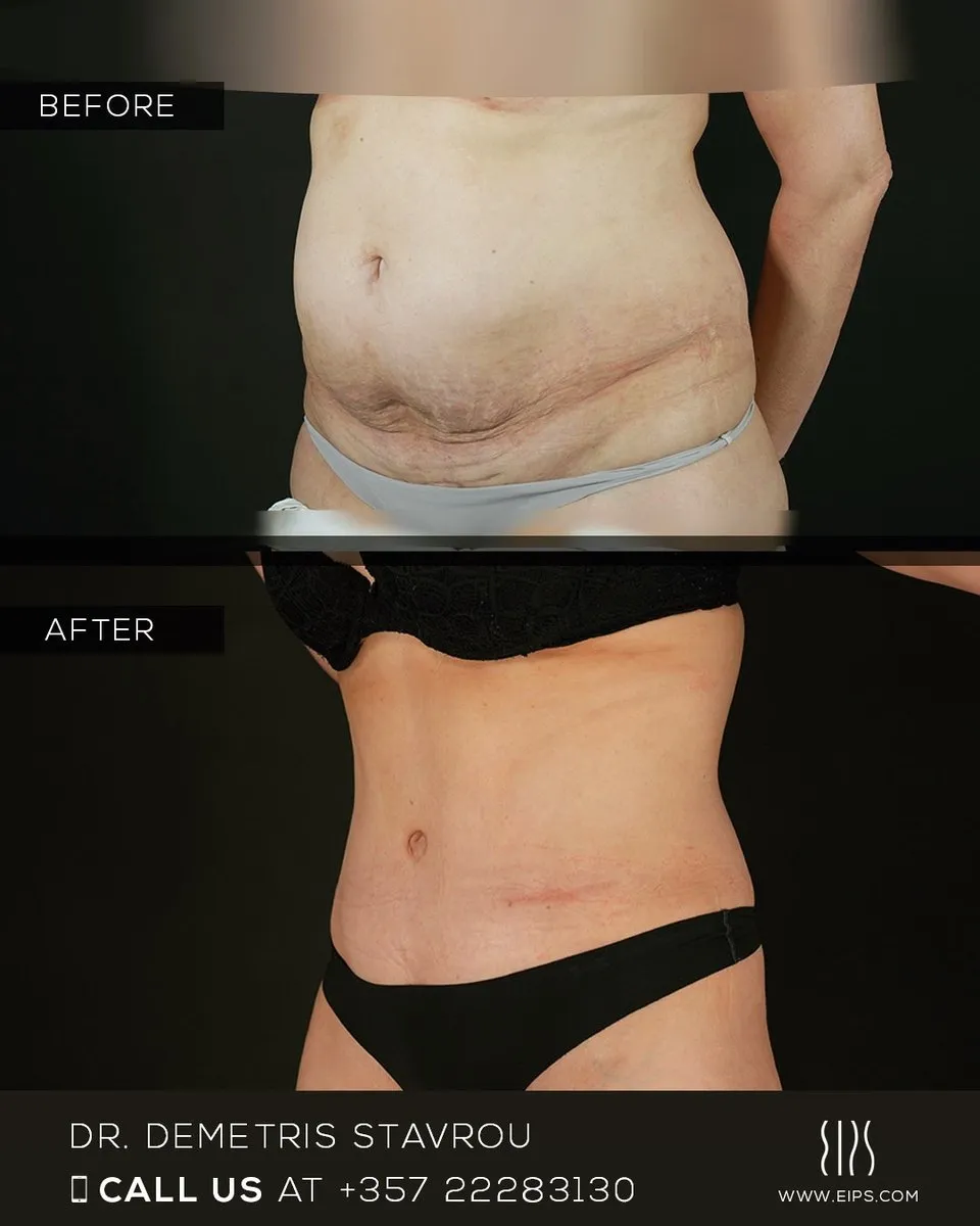 Abdominoplasty before and after