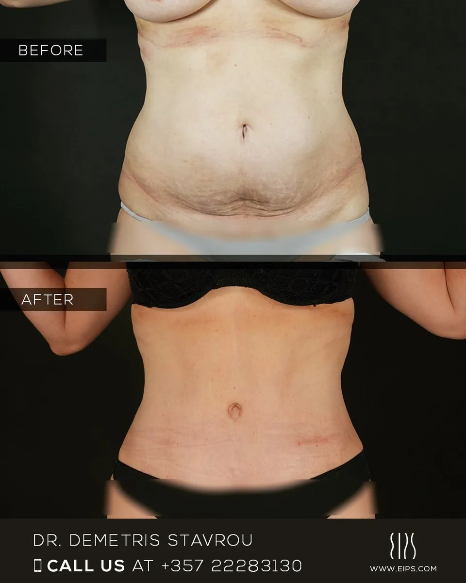 Abdominoplasty before and after