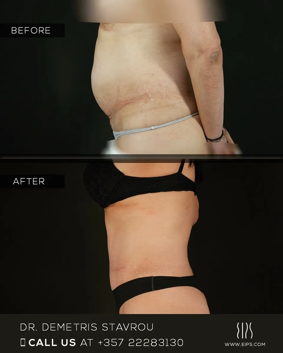 Abdominoplasty before and after