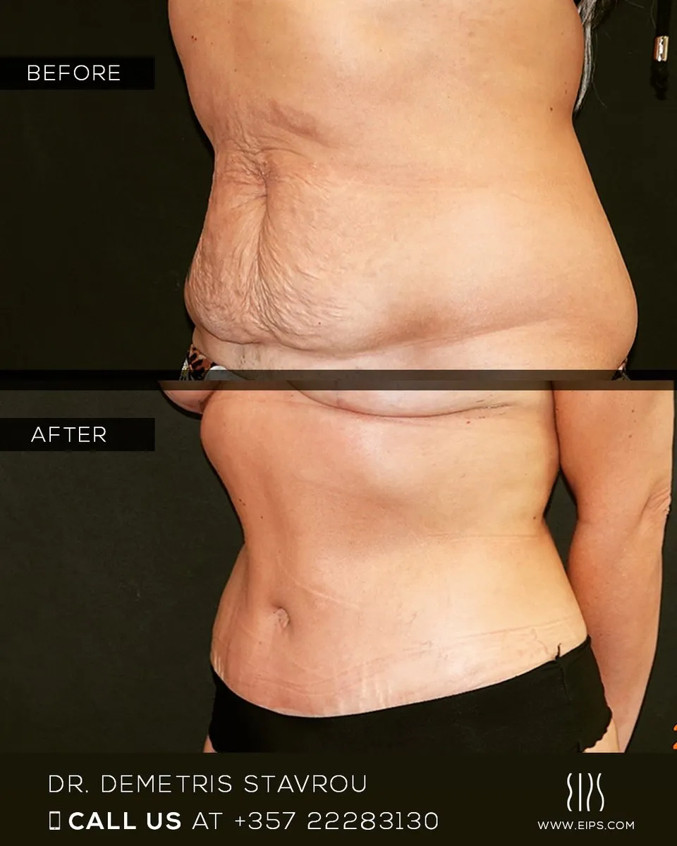 Abdominoplasty before and after
