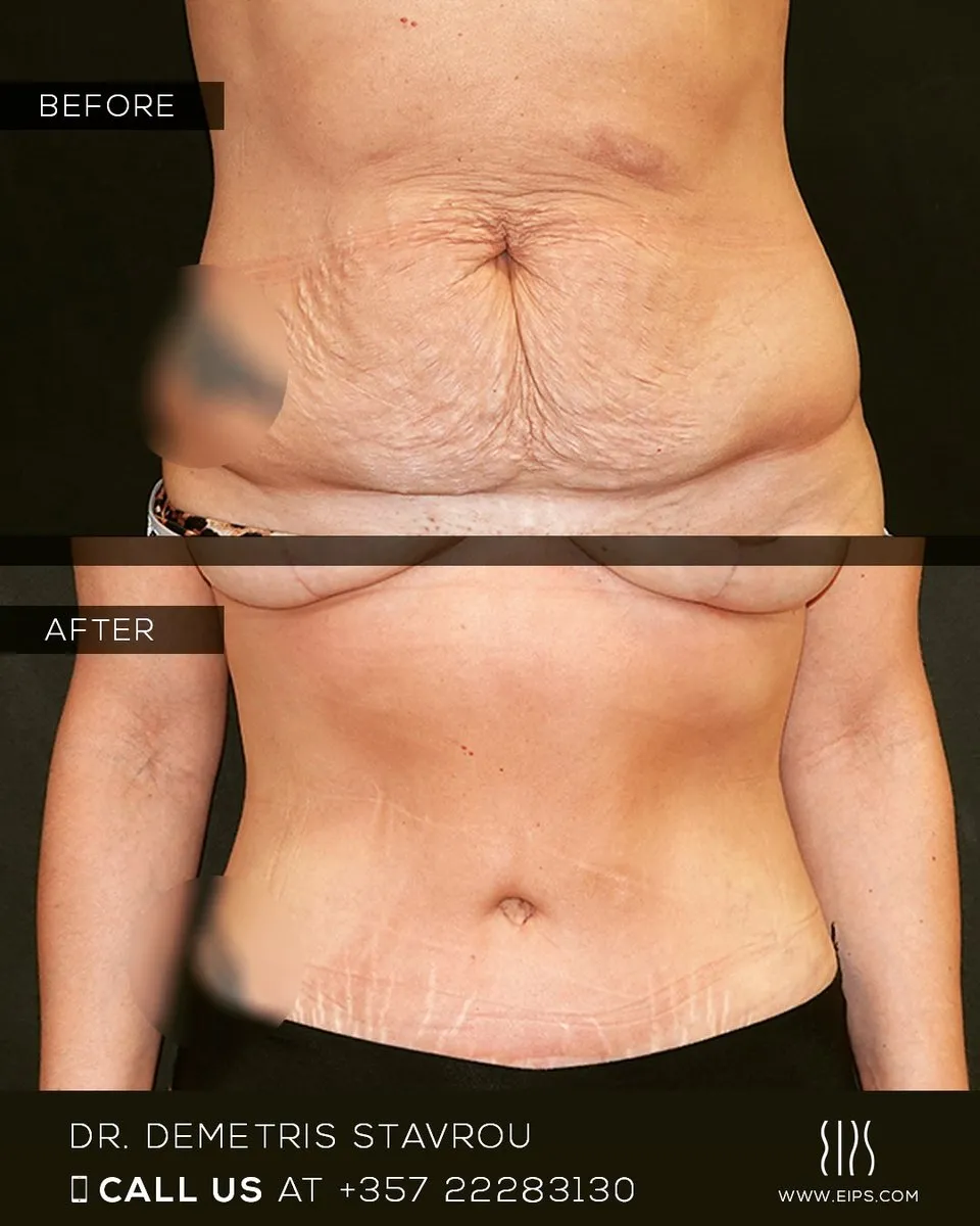 Abdominoplasty before and after