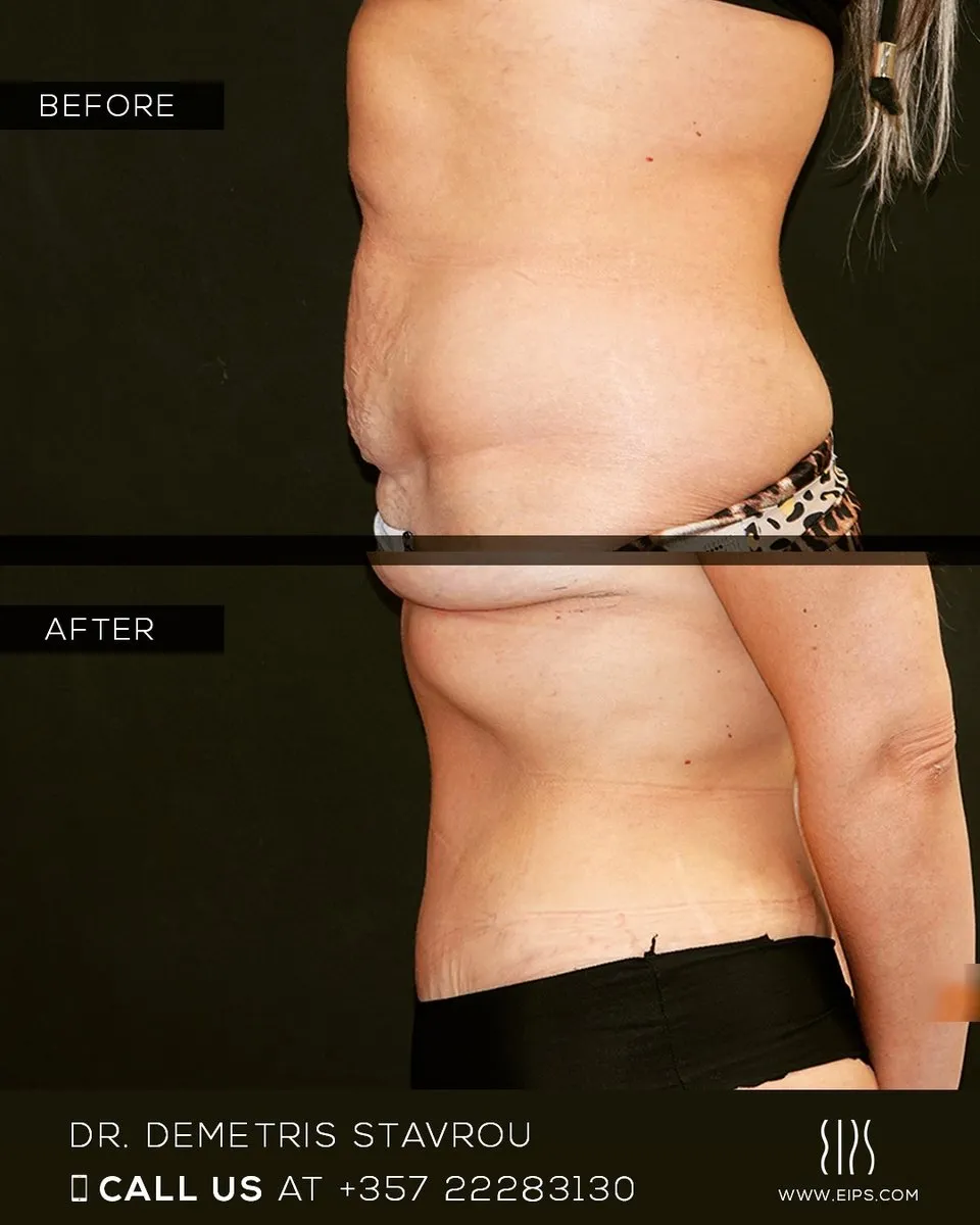 Abdominoplasty before and after