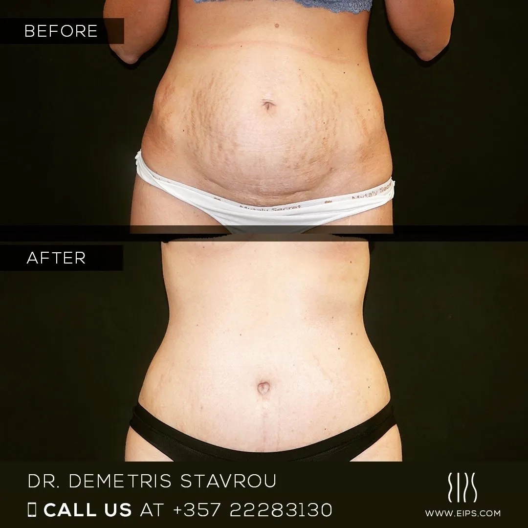 Abdominoplasty before and after