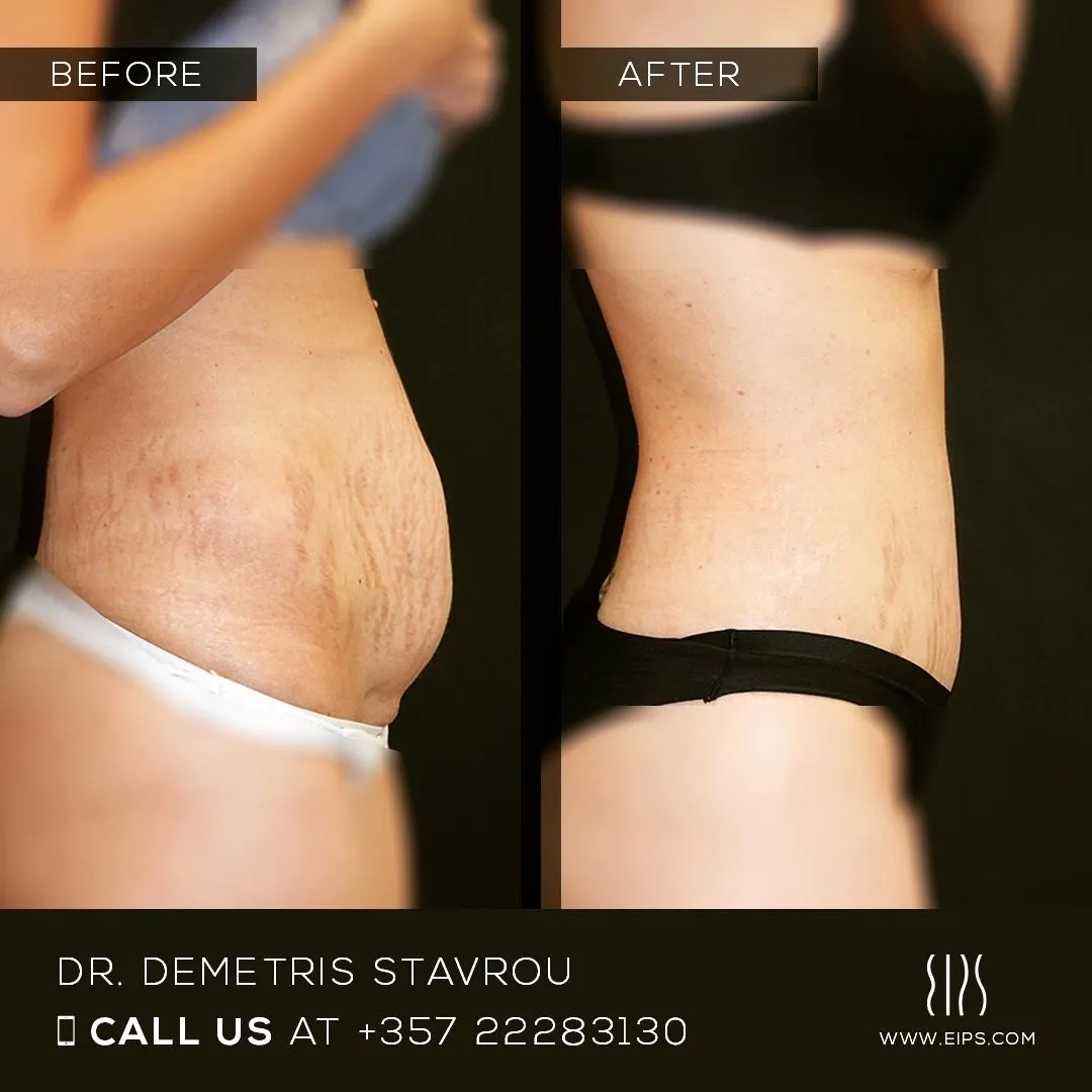 Abdominoplasty before and after