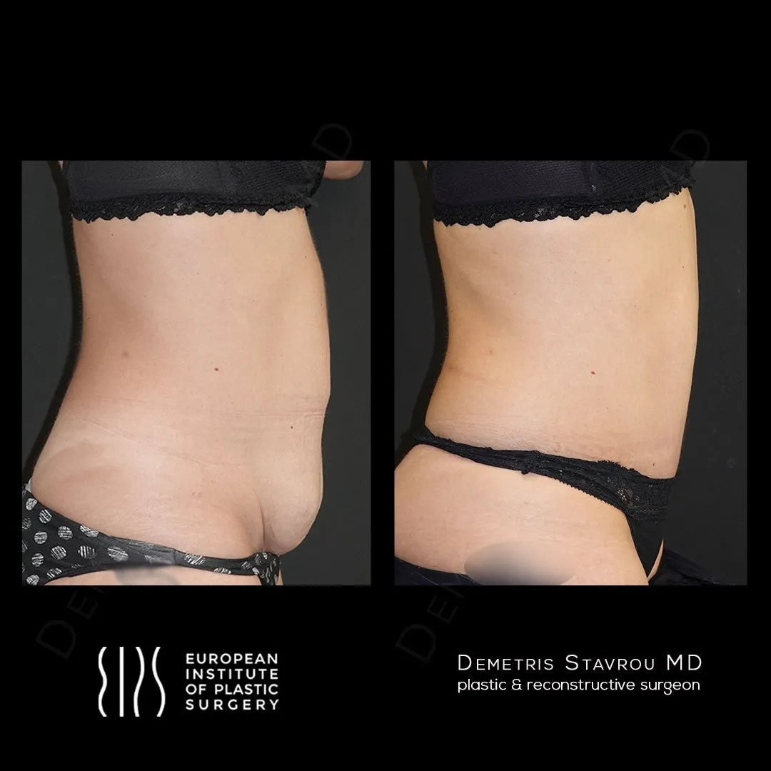 Abdominoplasty before and after