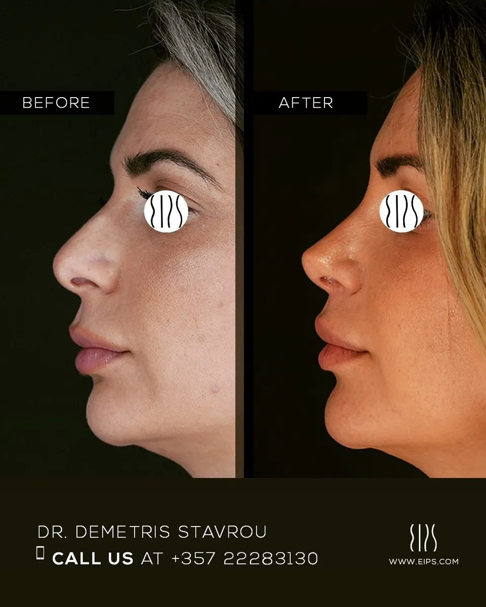 Blepharoplasty before and after
