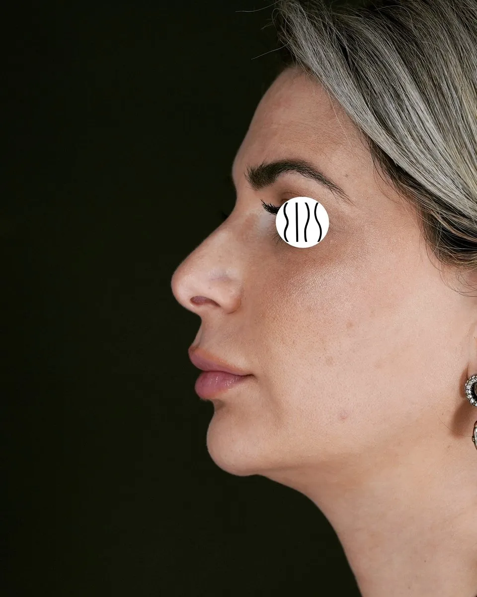 Blepharoplasty before and after