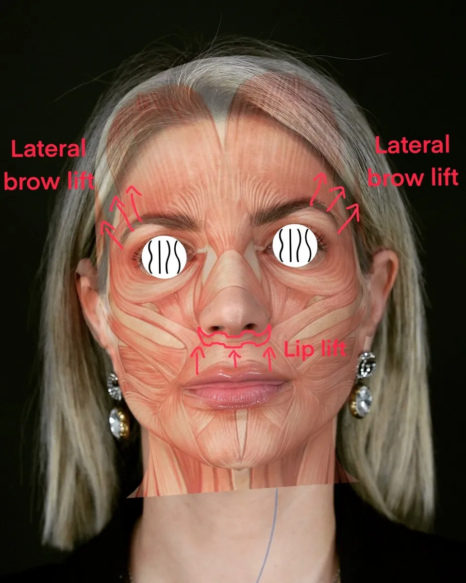 Blepharoplasty before and after