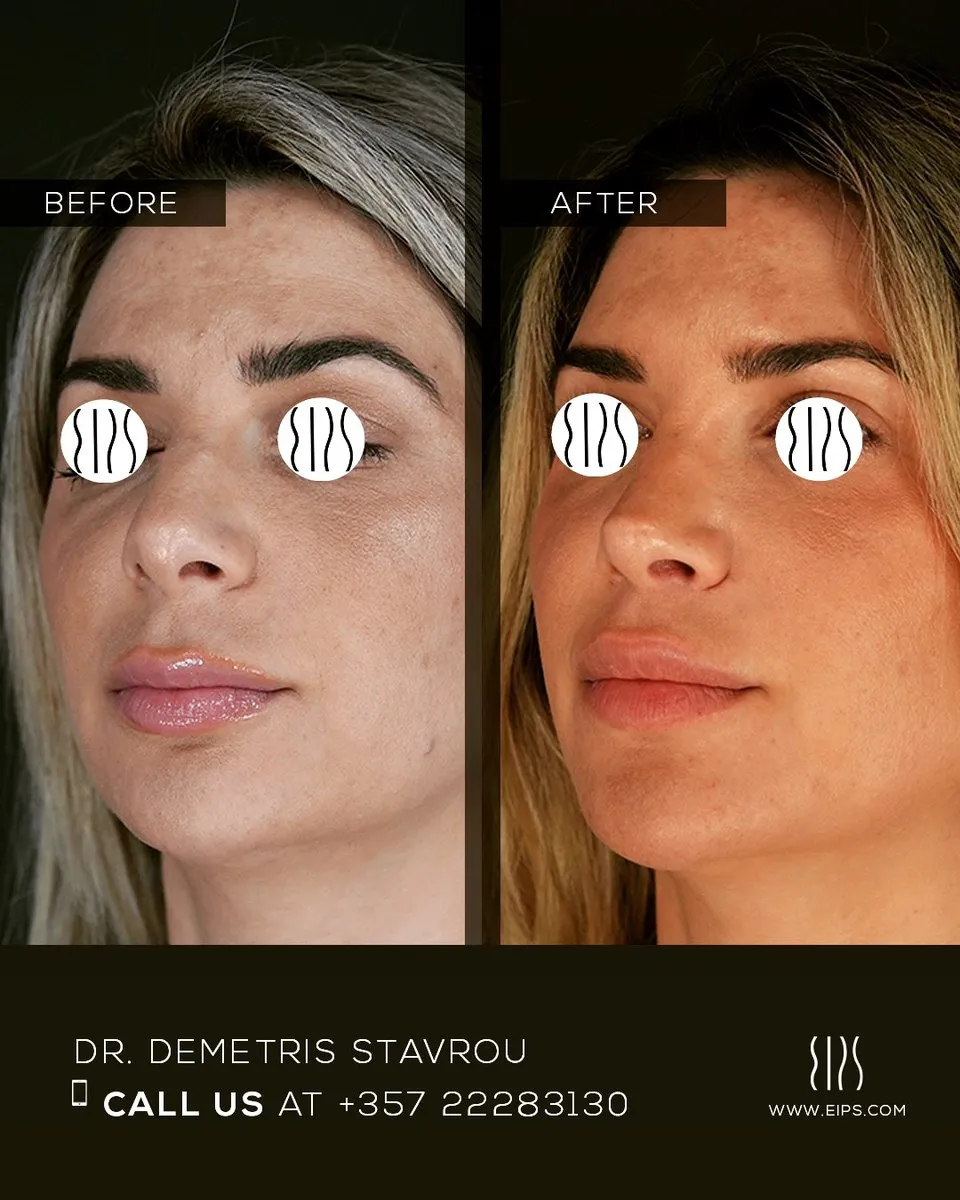 Blepharoplasty before and after