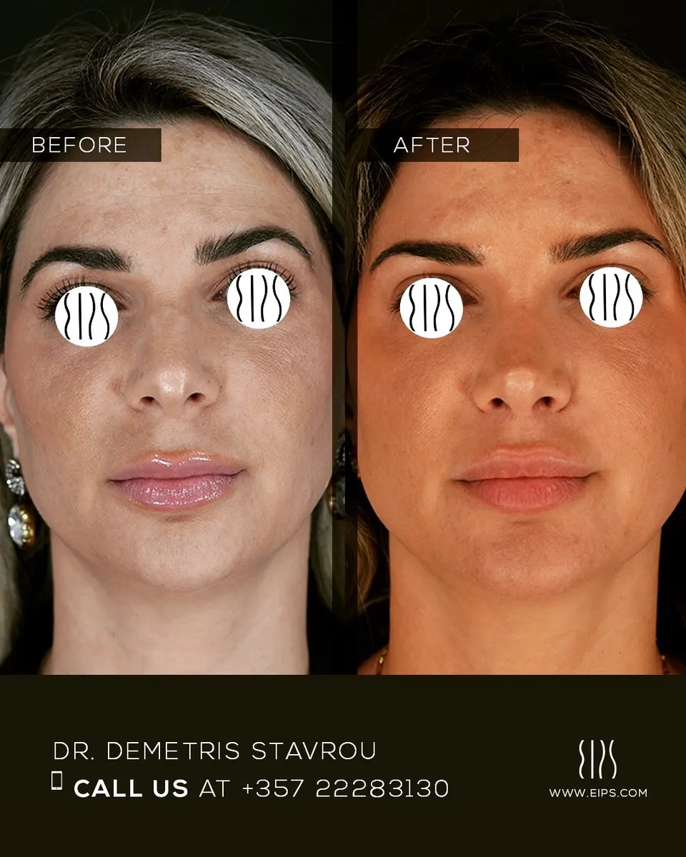Blepharoplasty before and after