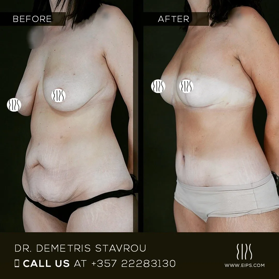 Body Contouring before and after