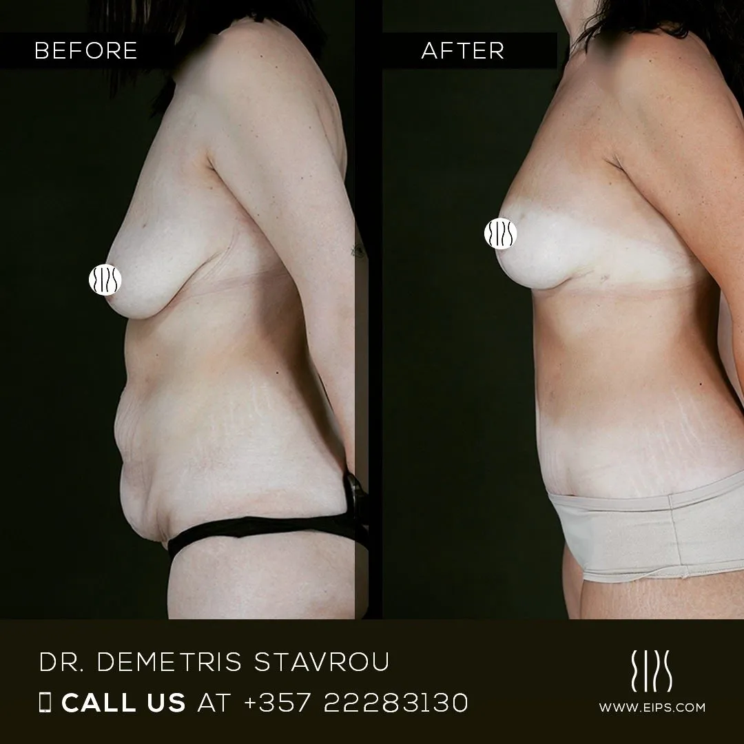 Body Contouring before and after