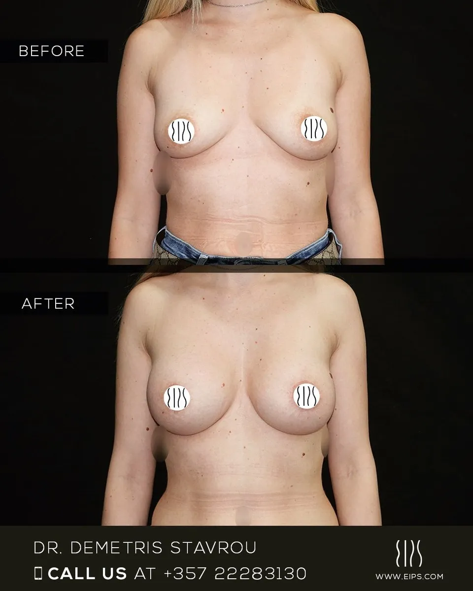 Breast Augmentation before and after
