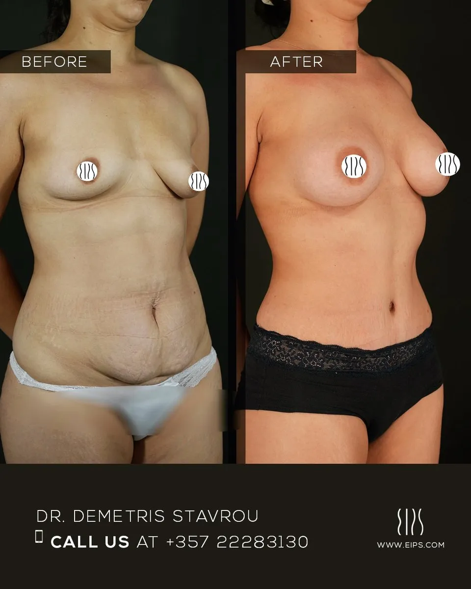 Breast Augmentation before and after