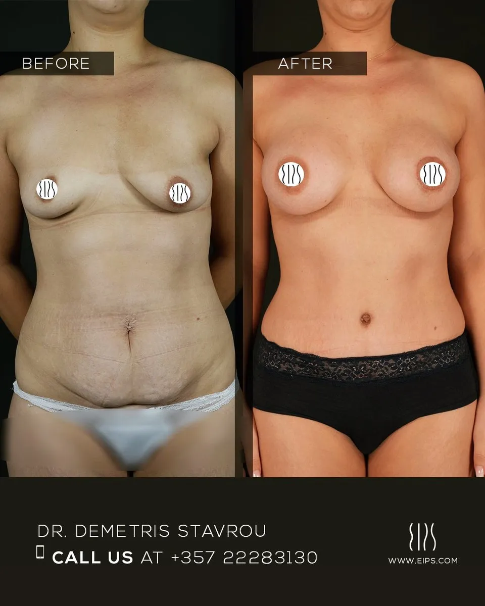 Breast Augmentation before and after