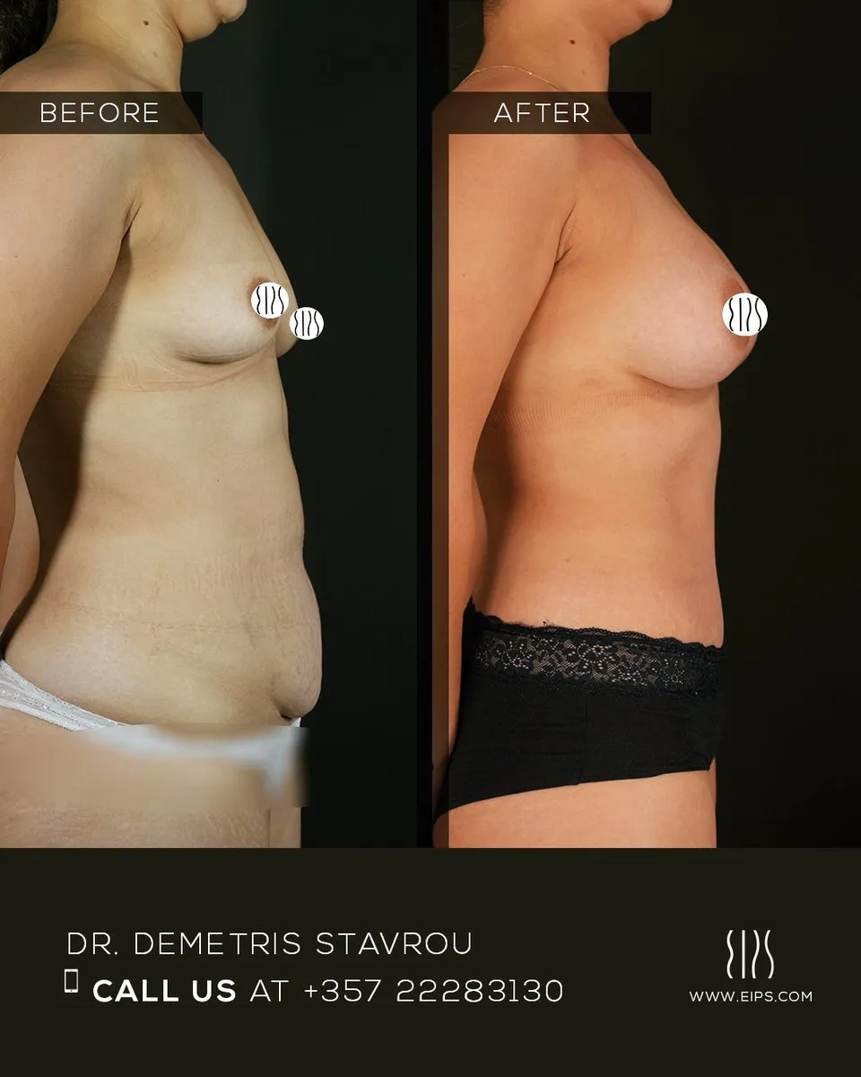 Breast Augmentation before and after