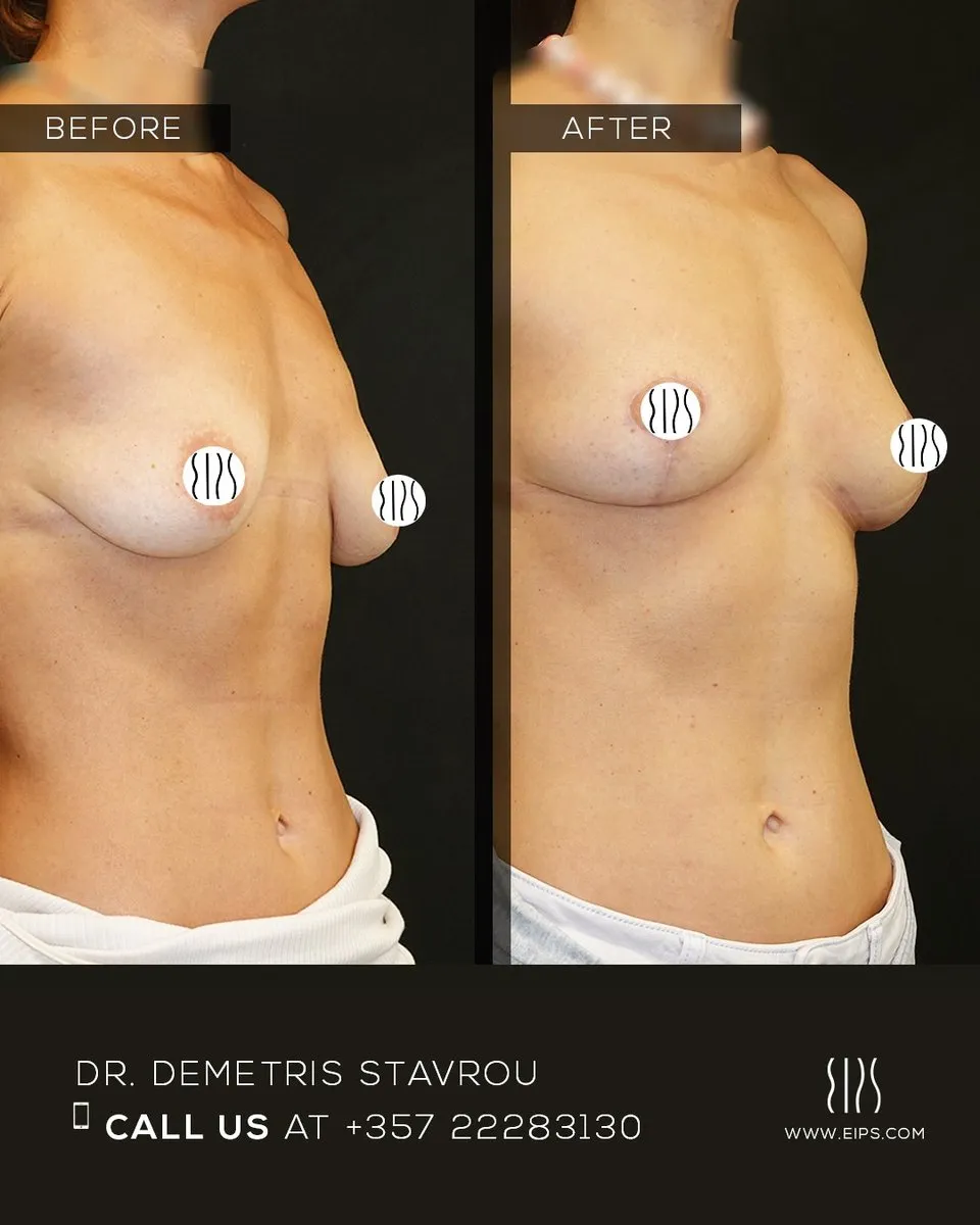 Breast Augmentation before and after