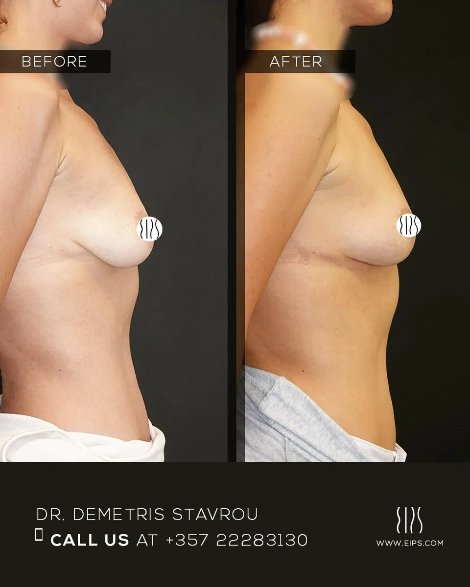 Breast Augmentation before and after