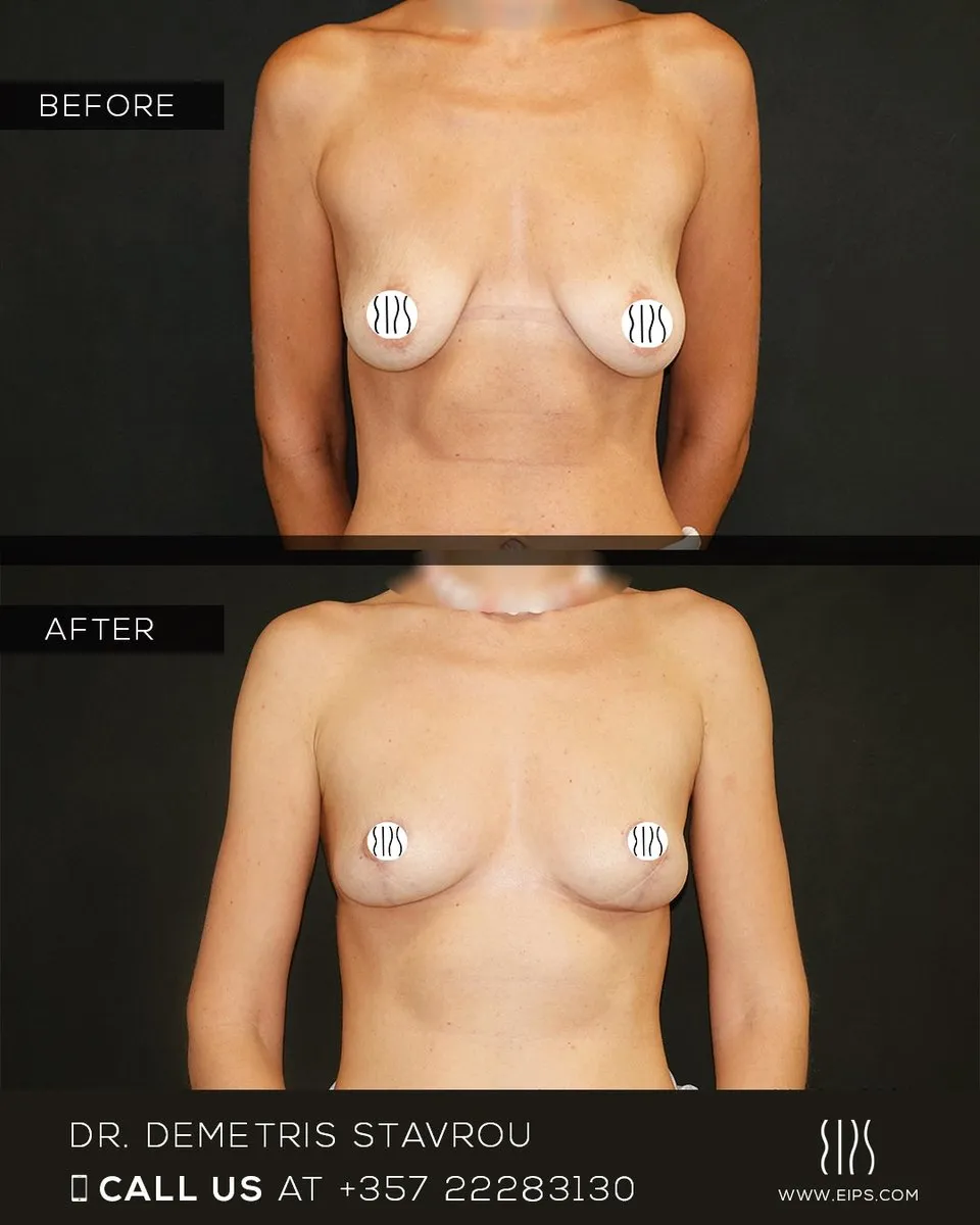 Breast Augmentation before and after