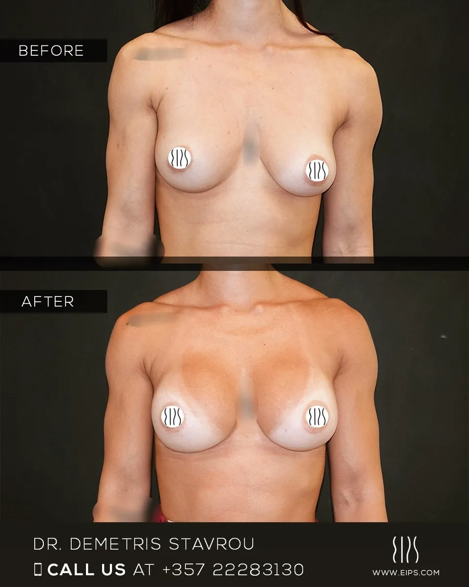 Breast Augmentation before and after