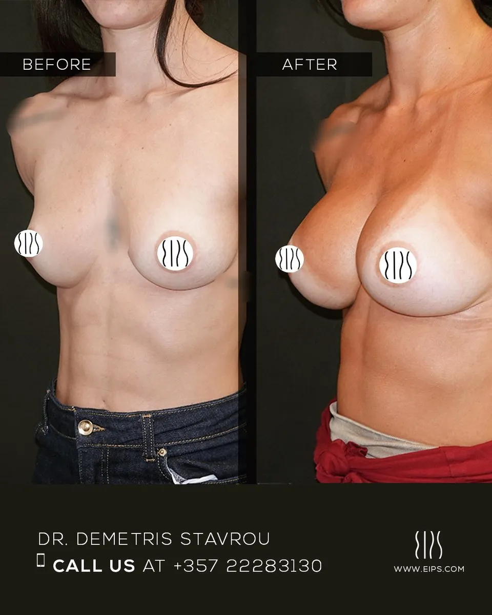 Breast Augmentation before and after