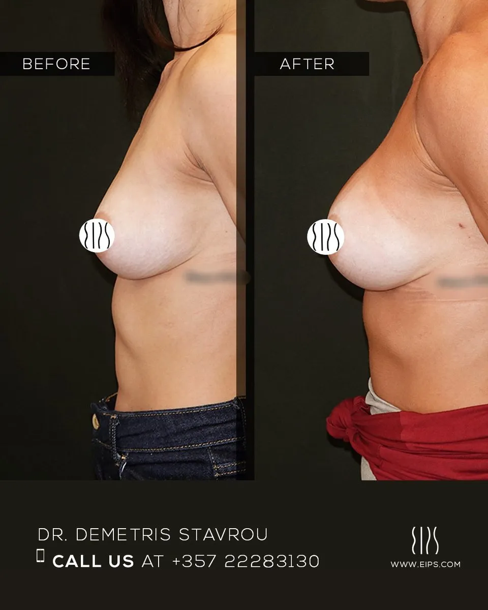 Breast Augmentation before and after