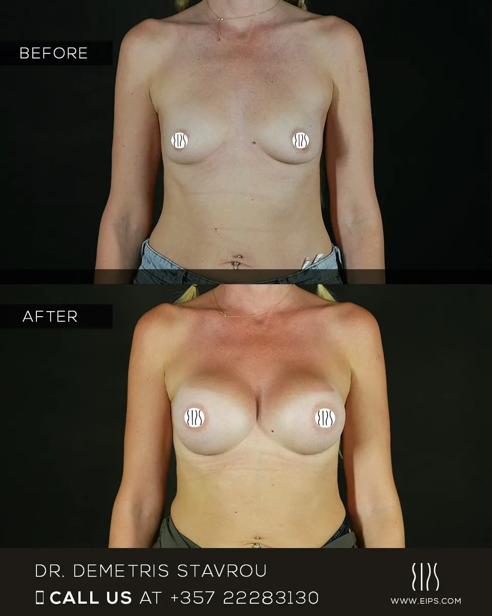 Breast Augmentation before and after