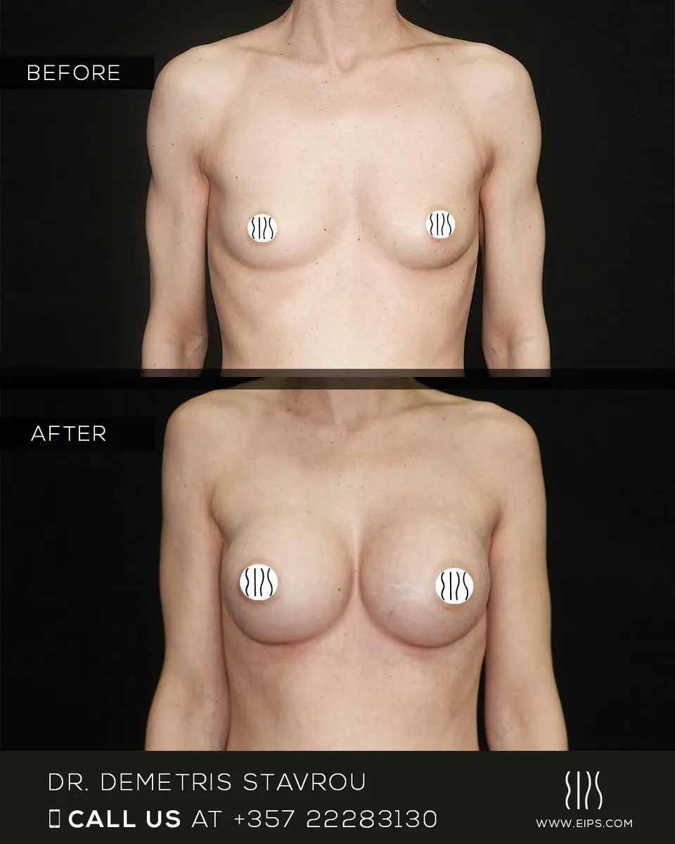 Breast Augmentation before and after
