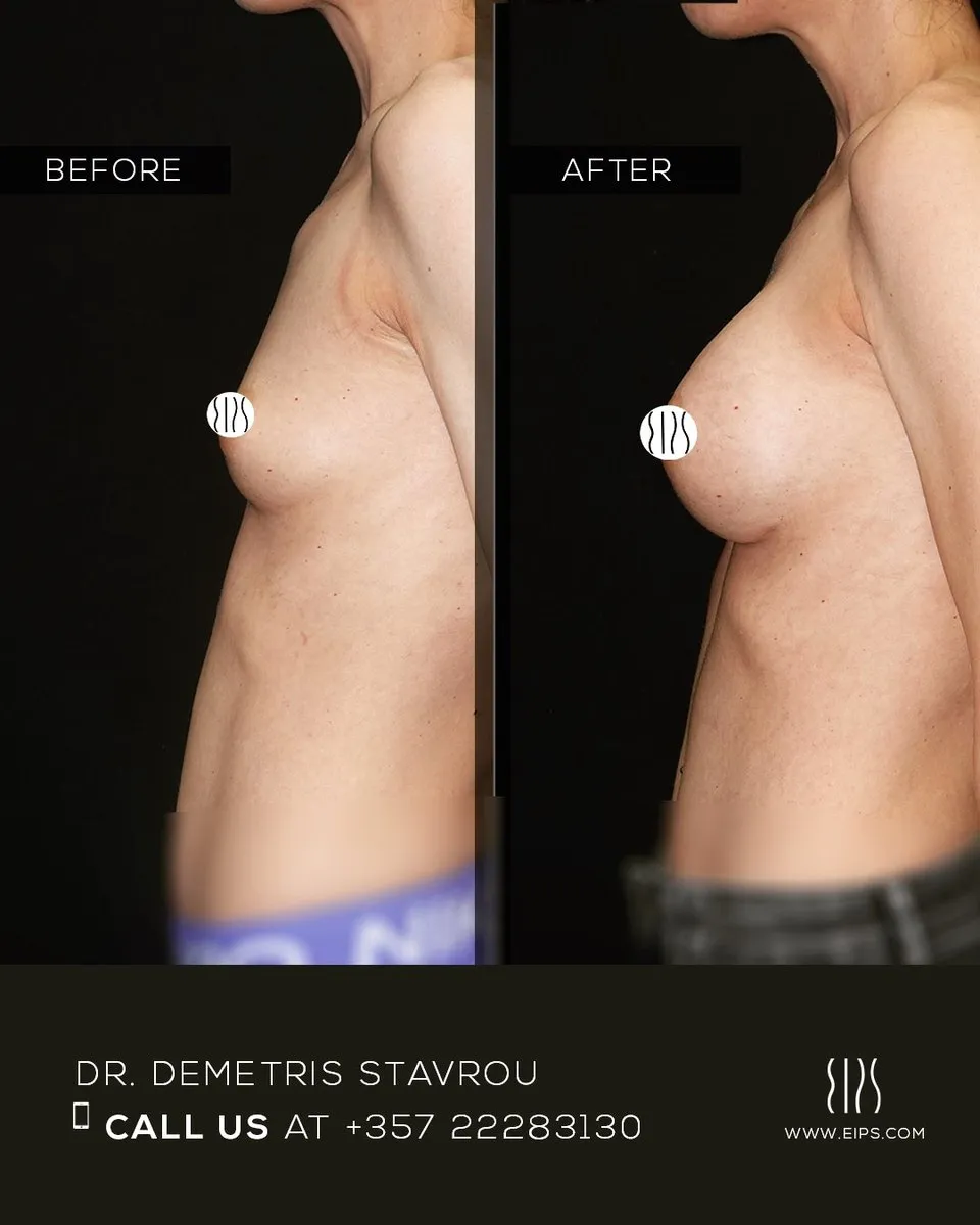 Breast Augmentation before and after