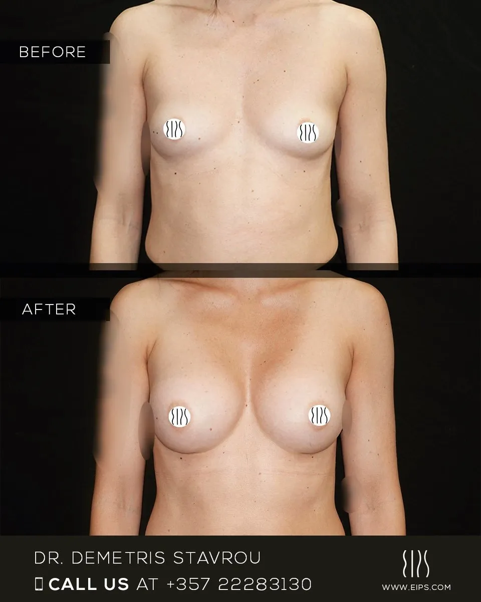 Breast Augmentation before and after