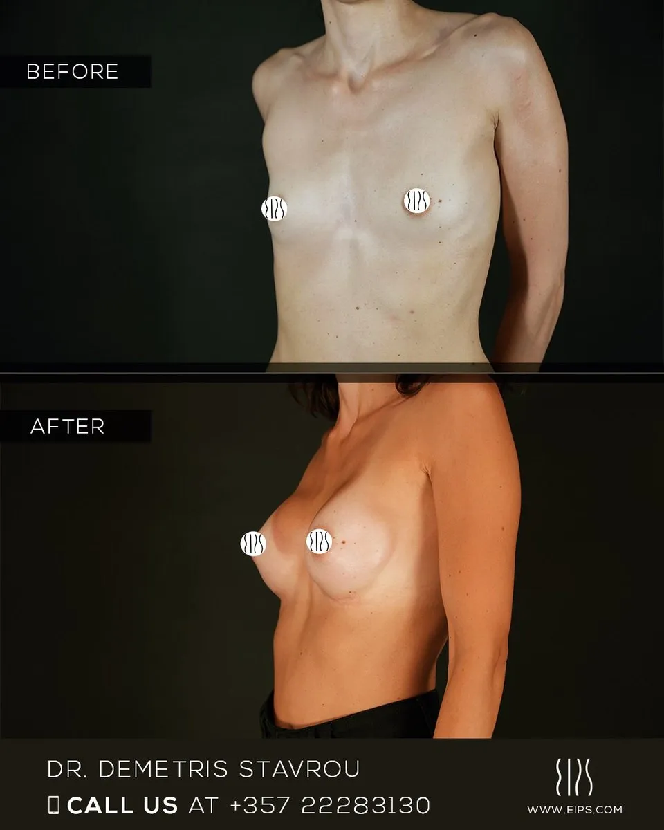 Breast Augmentation before and after