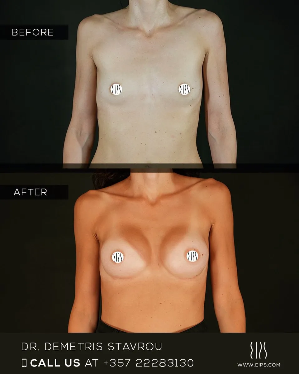 Breast Augmentation before and after