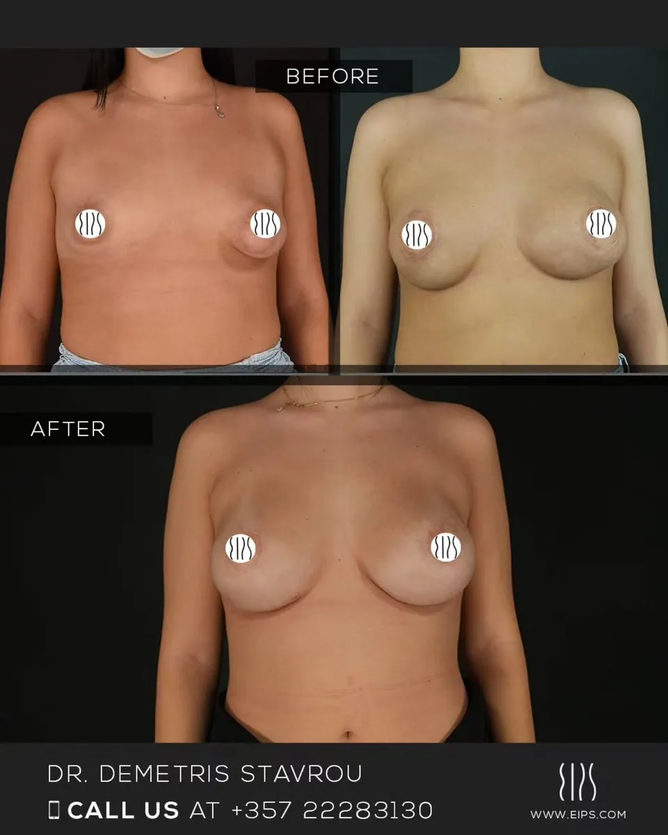 Breast Augmentation before and after