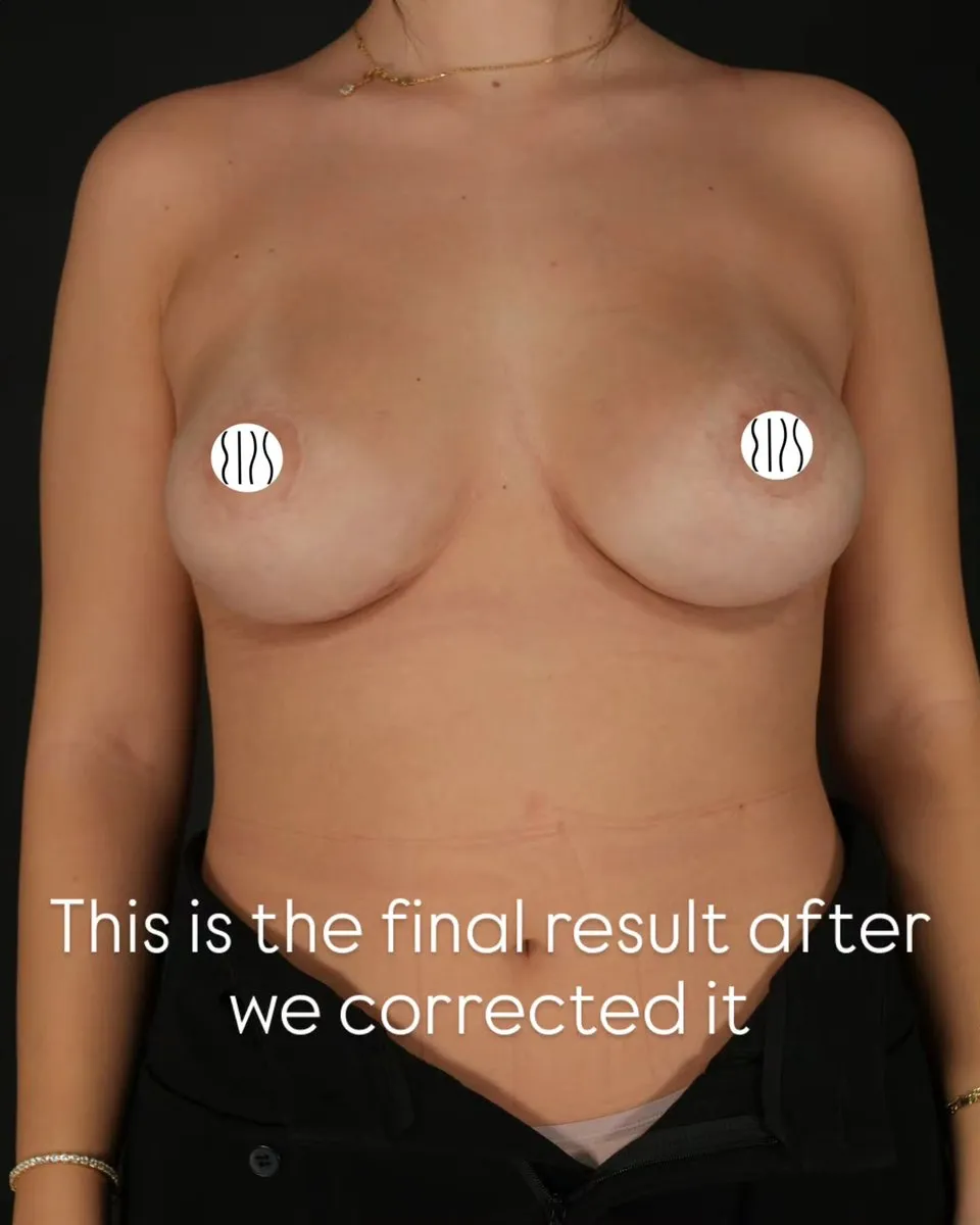 Breast Augmentation before and after