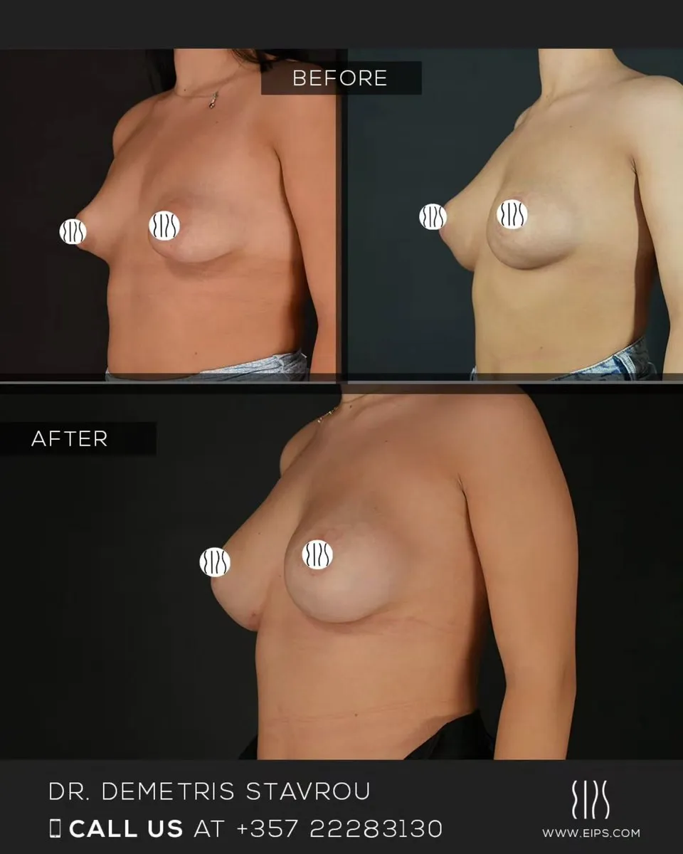 Breast Augmentation before and after