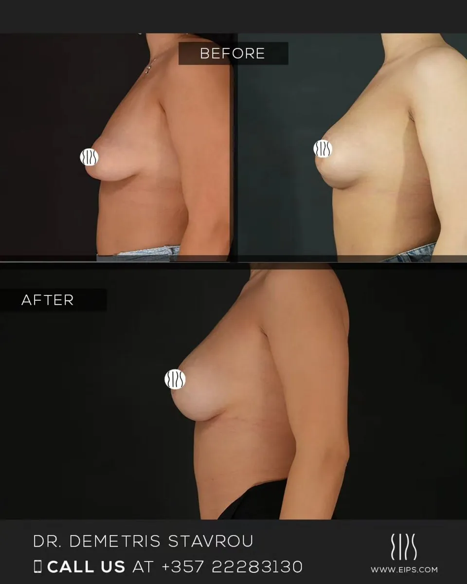 Breast Augmentation before and after