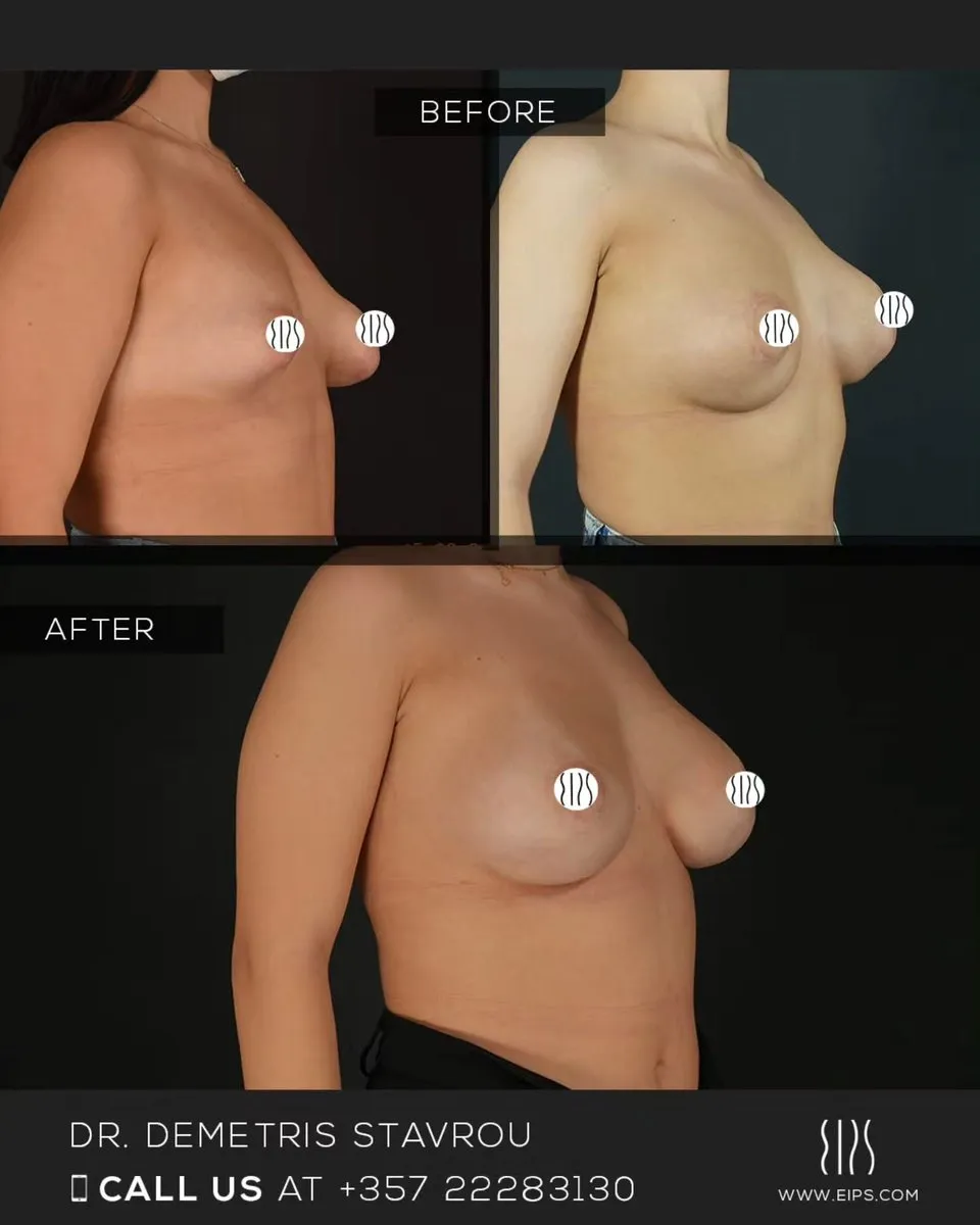 Breast Augmentation before and after