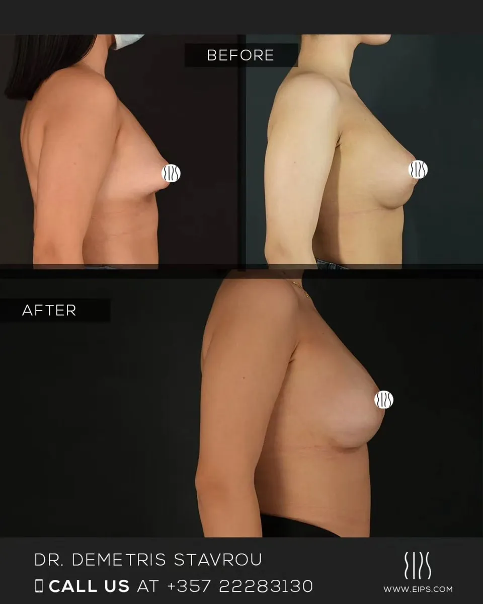 Breast Augmentation before and after