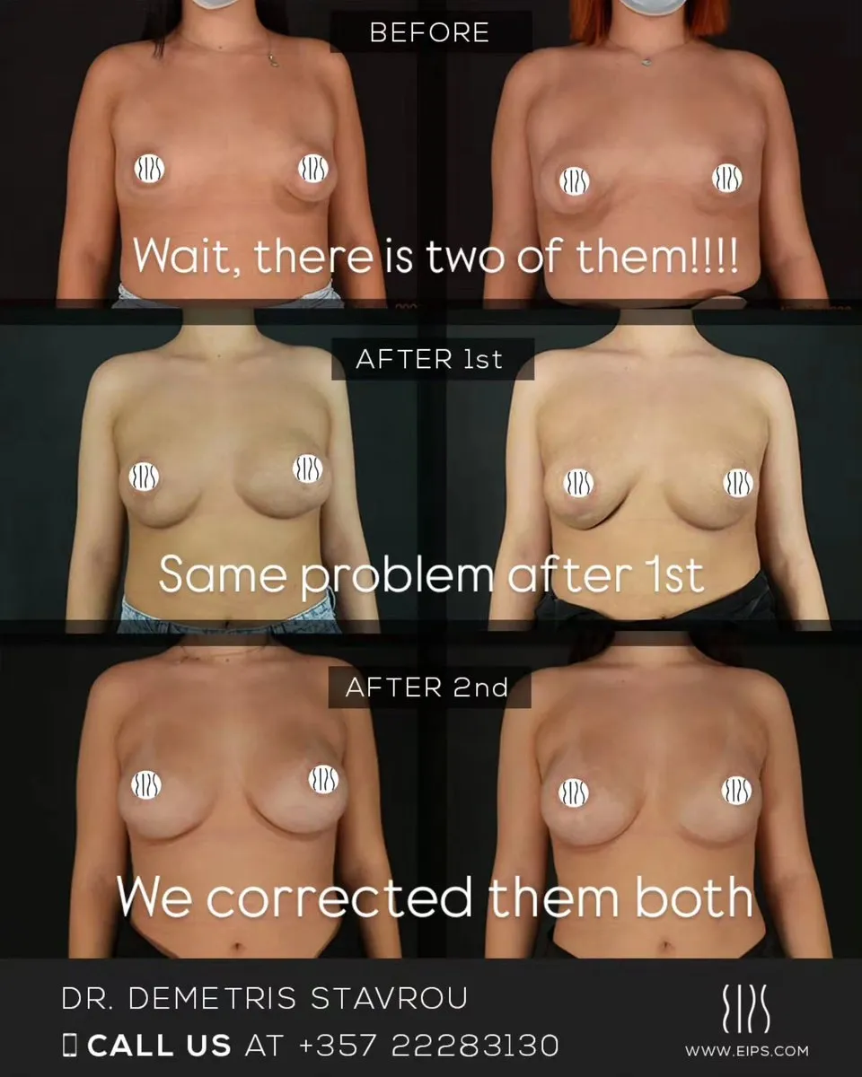 Breast Augmentation before and after