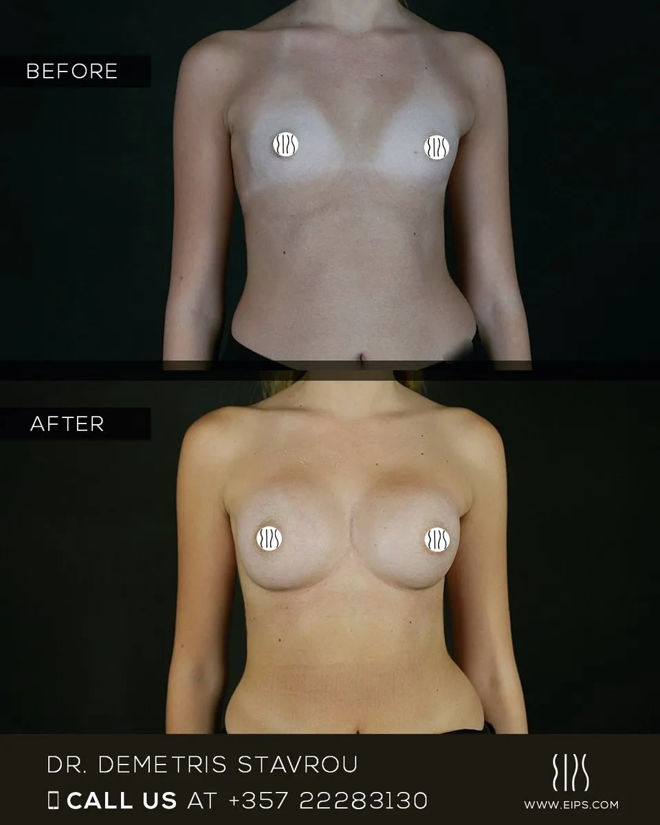 Breast Augmentation before and after