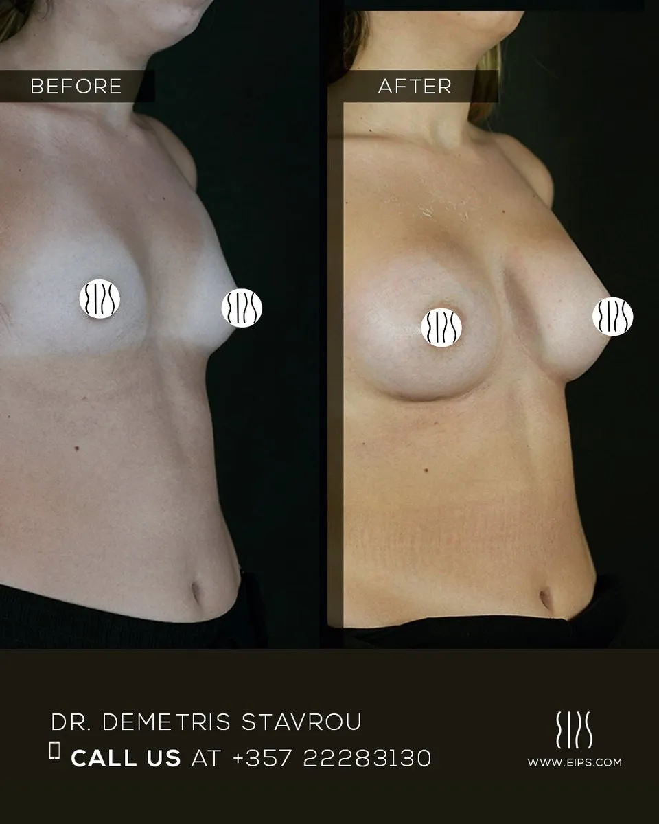 Breast Augmentation before and after