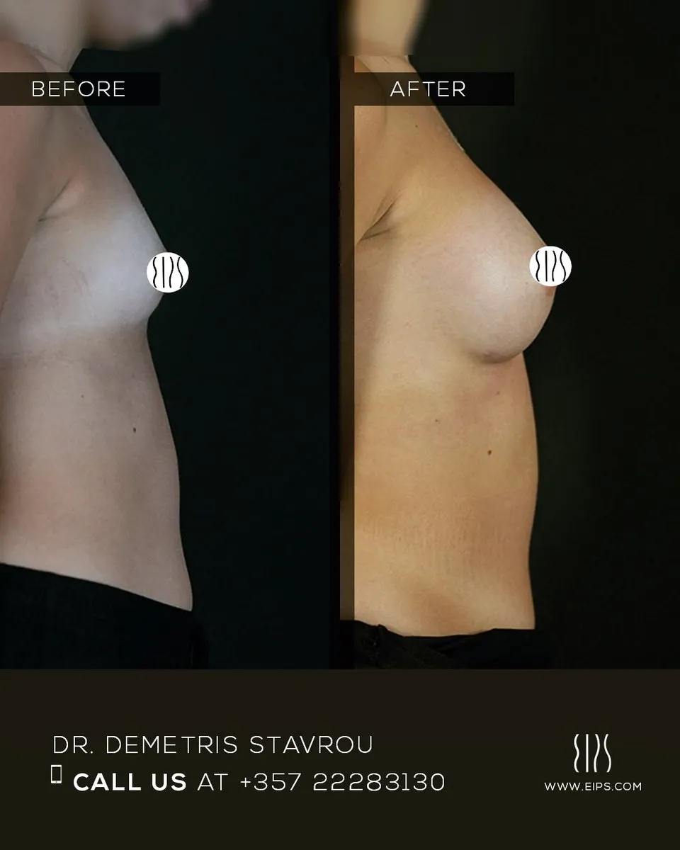Breast Augmentation before and after