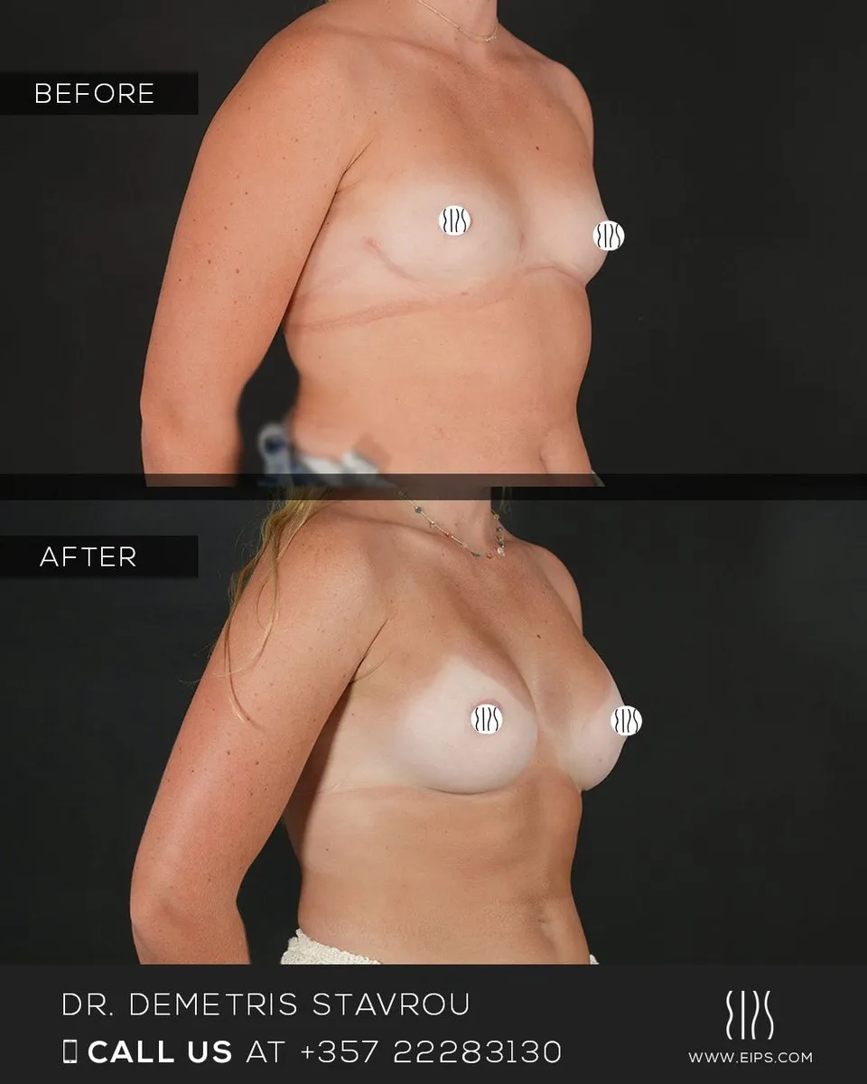 Breast Augmentation before and after