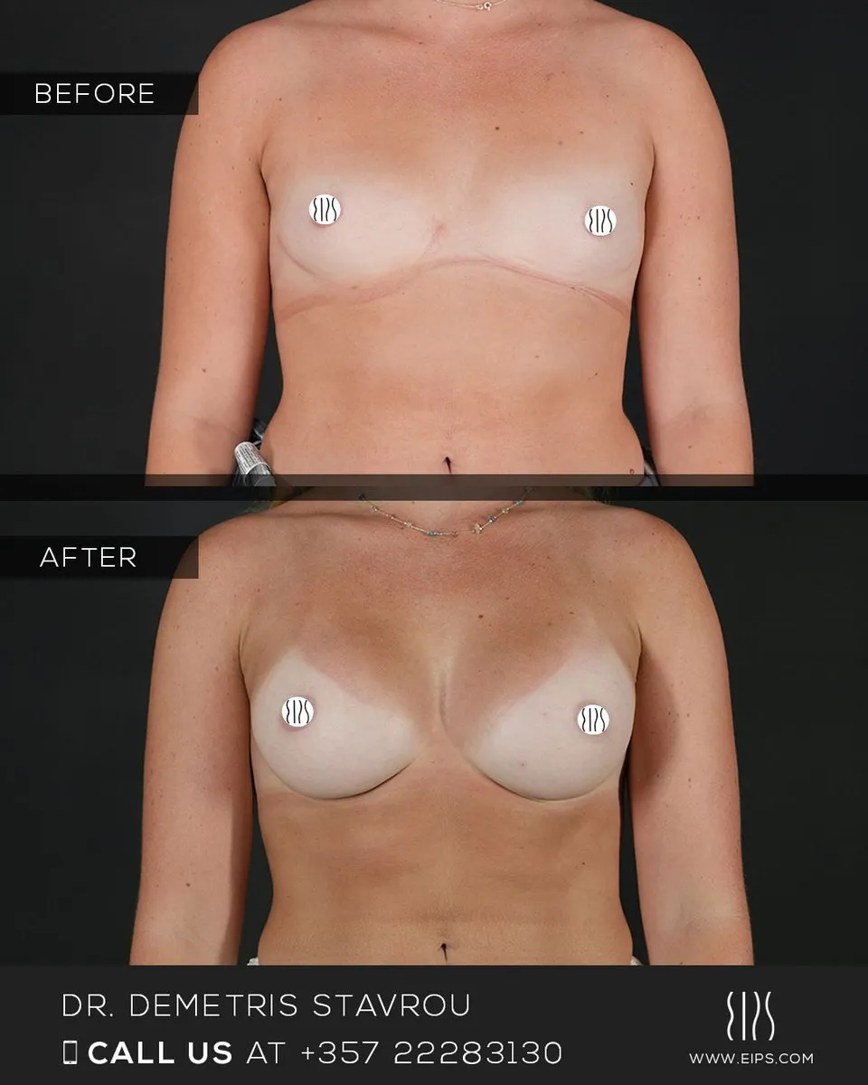 Breast Augmentation before and after