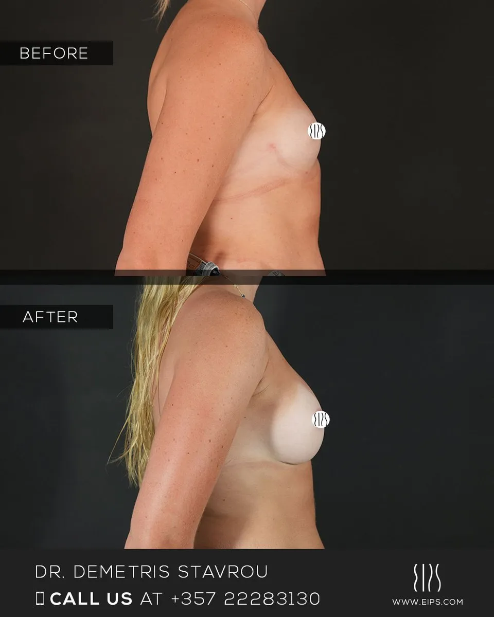 Breast Augmentation before and after