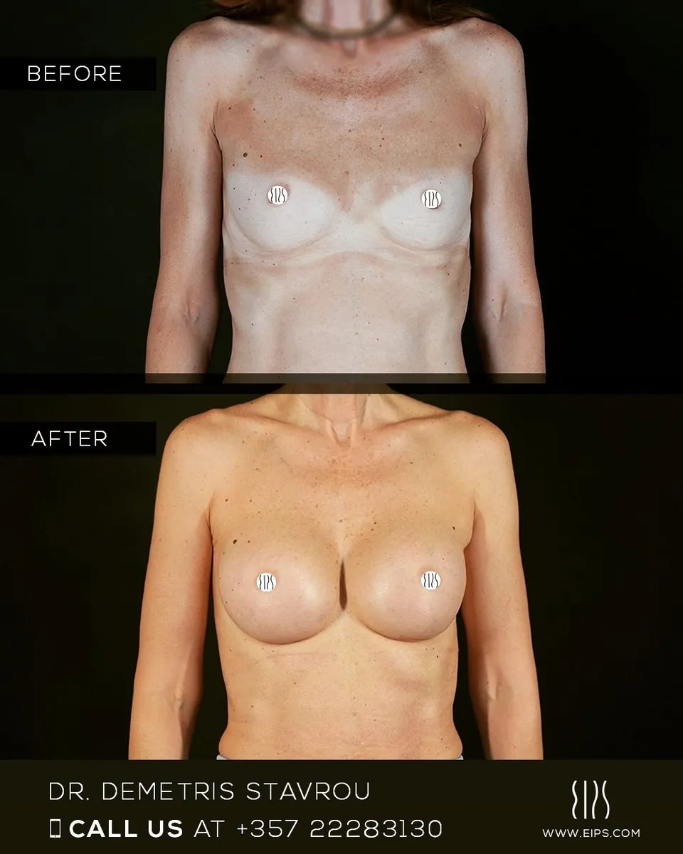 Breast Augmentation before and after