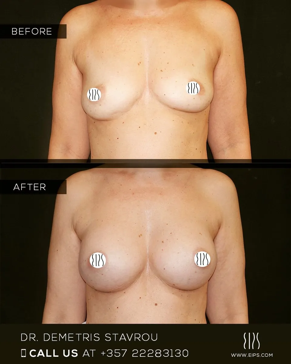 Breast Augmentation before and after