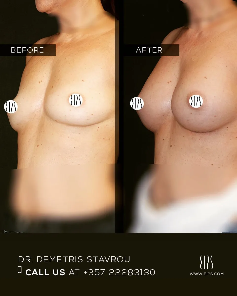 Breast Augmentation before and after