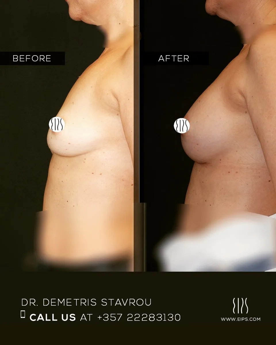 Breast Augmentation before and after