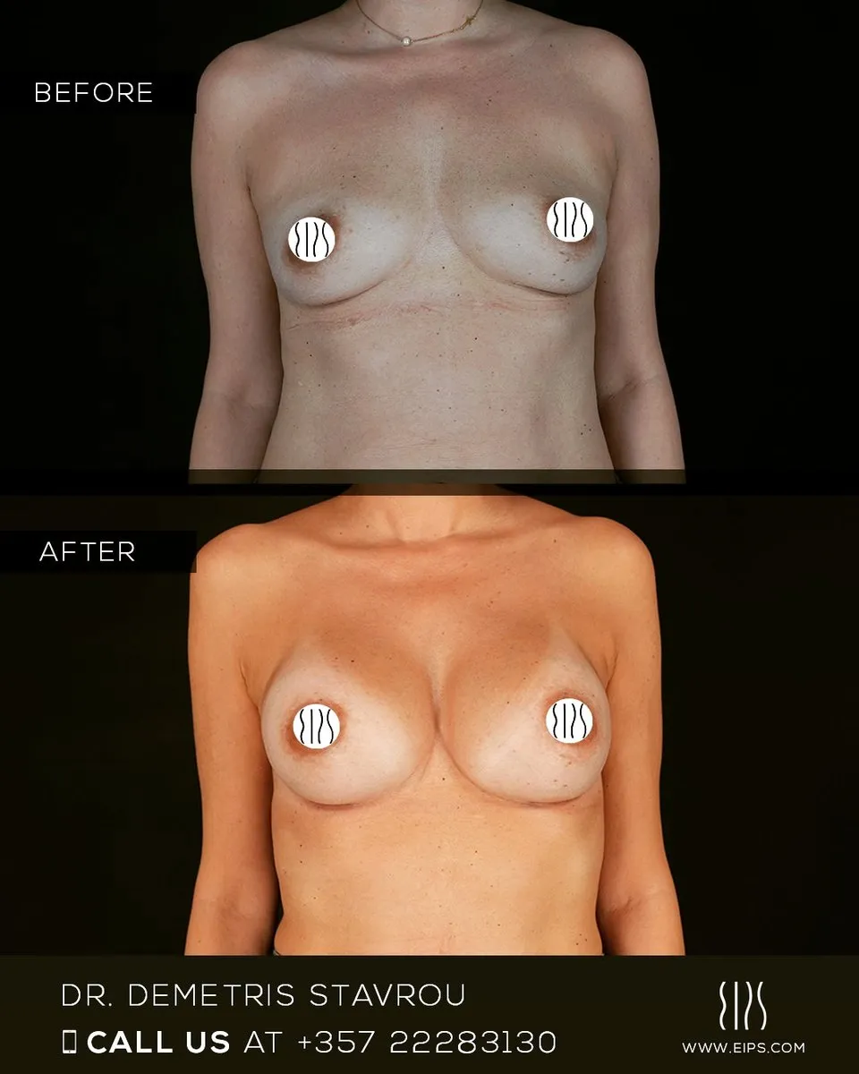 Breast Augmentation before and after